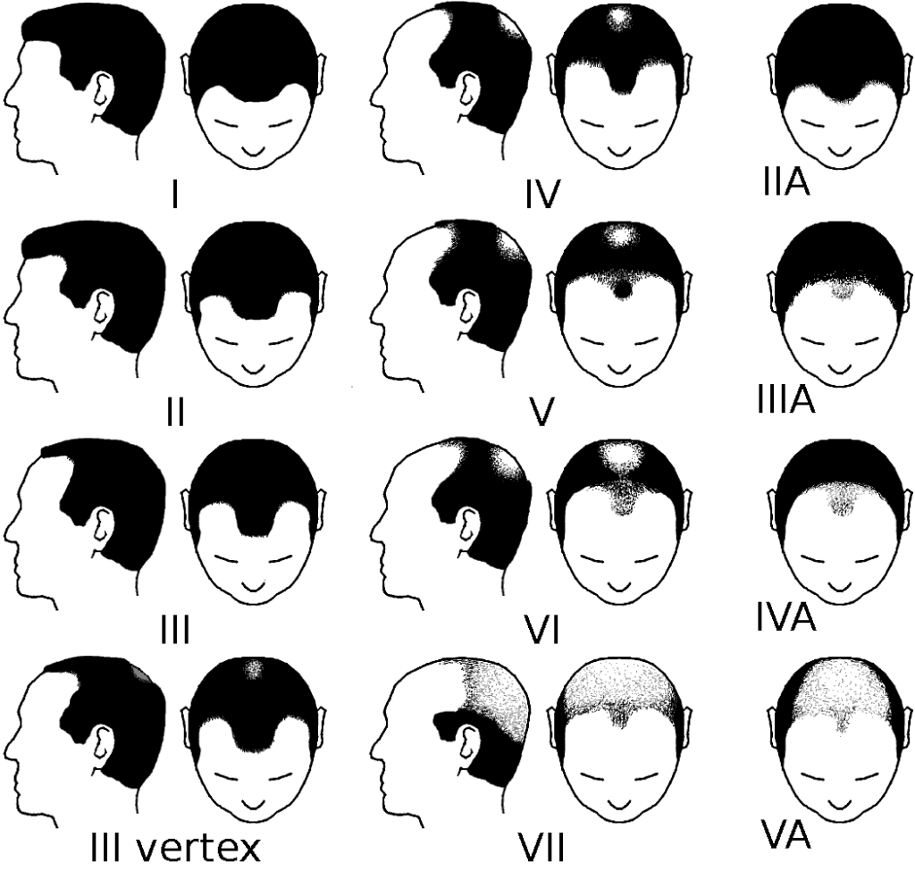 schémas de l'alopecie chez les hommes